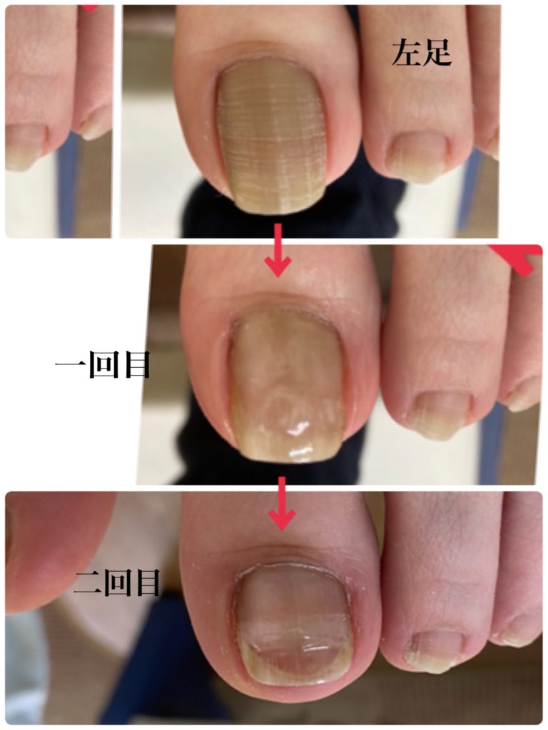 この度は口コミのご投稿ありがとうございます。 高評価をいただき大変嬉しく思います。 これからも安心して通っていただけるよう、丁寧な対応と施術を心がけてまいります。 また足や爪で気になることがありましたら、いつでもお気軽にご相談ください。 蒲田雑色巻き爪センター