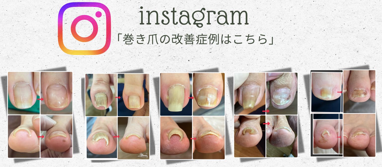 巻き爪改善症例｜横浜鶴見巻き爪センター